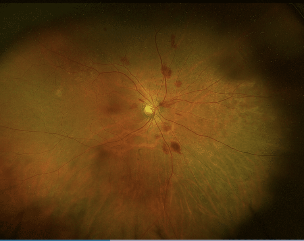 Small Roth Spot Retinal Review: July 2022 - OOMC
