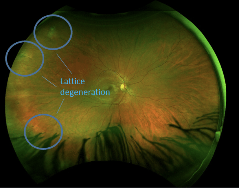 Atrophic Retinal Hole Atrophic Retinal Hole