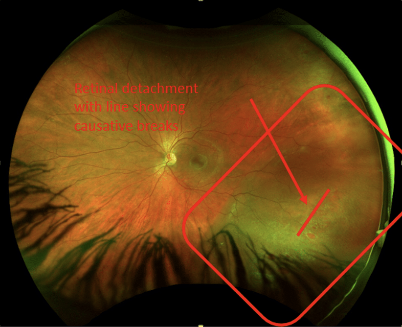 Atrophic Retinal Hole Atrophic Retinal Hole